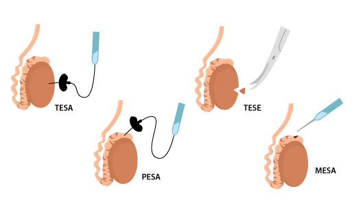 بازیابی اسپرم به روش جراحی (روش MESA یا TESE)